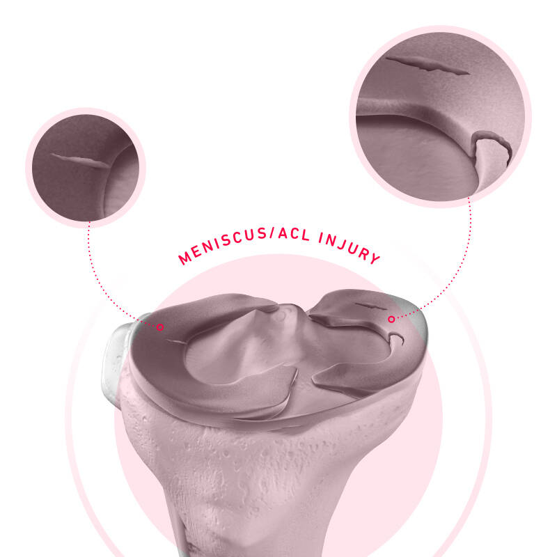 Ein Meniskusriss ist das (vorläufige) Ende vieler Sportlerkarrieren Schematische Darstellung eines Meniskusrisses an einem Modell des Kniegelenks