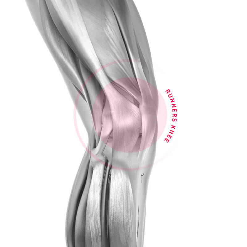 Runners Knee (ITBS) als Ursache für Knieschmerzen beim Laufen Schematische Darstellung des schmerzenden Areals bei einem Läuferknie
